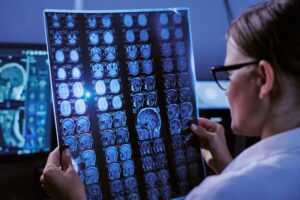 esclerosis múltiple