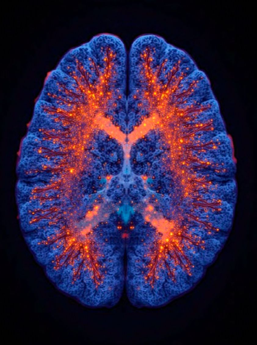 Tratamiento del Insomnio con NESA