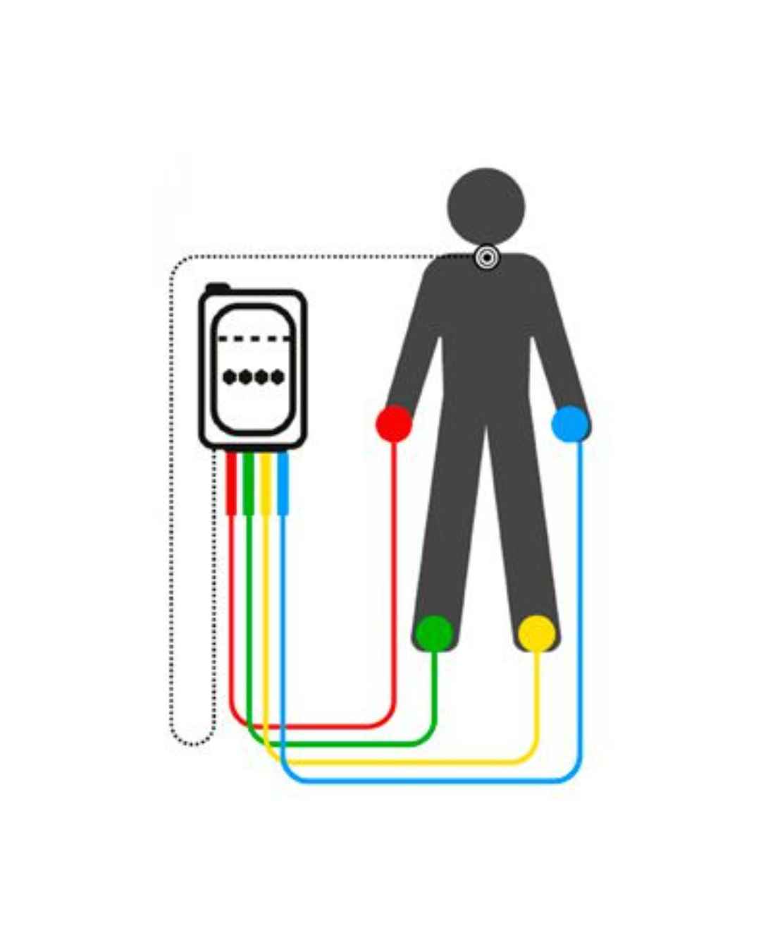 neuromodulación no invasiva NESA